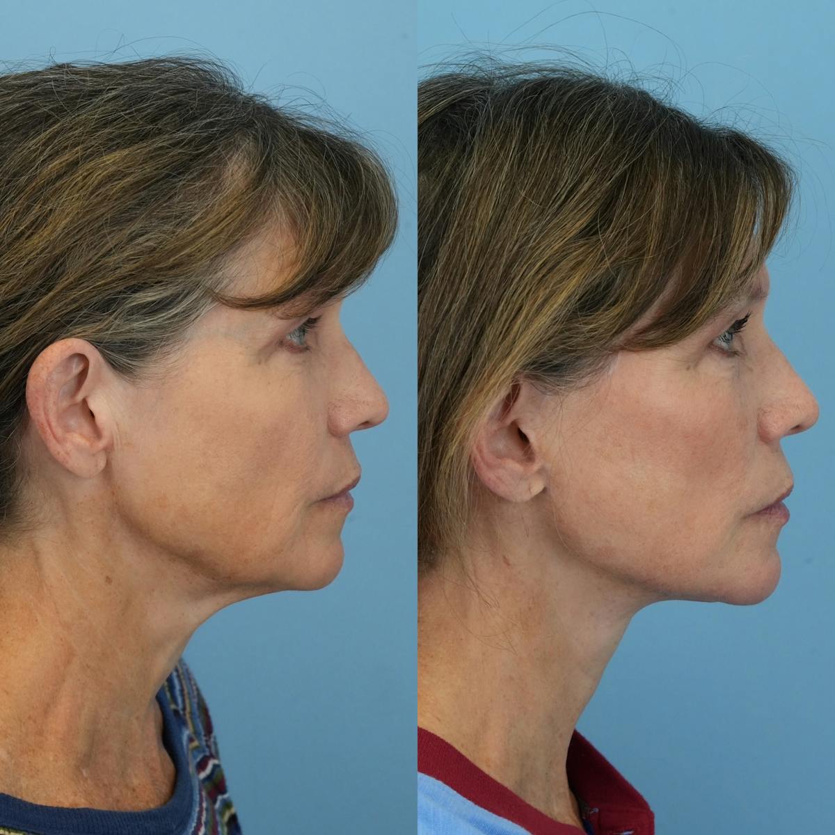 Facelift Before & After Gallery - Patient 222593 - Image 3