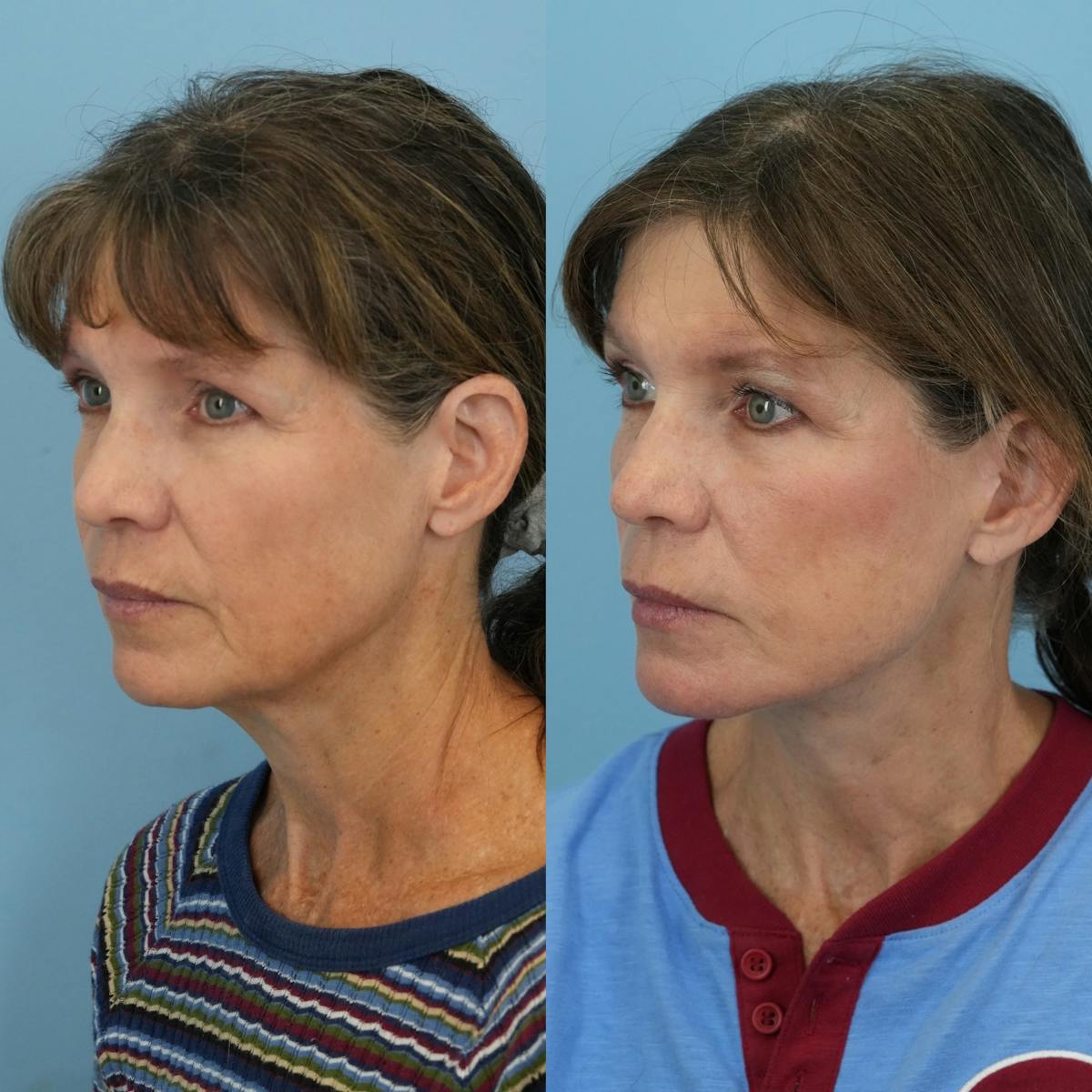 Facelift Before & After Gallery - Patient 222593 - Image 4