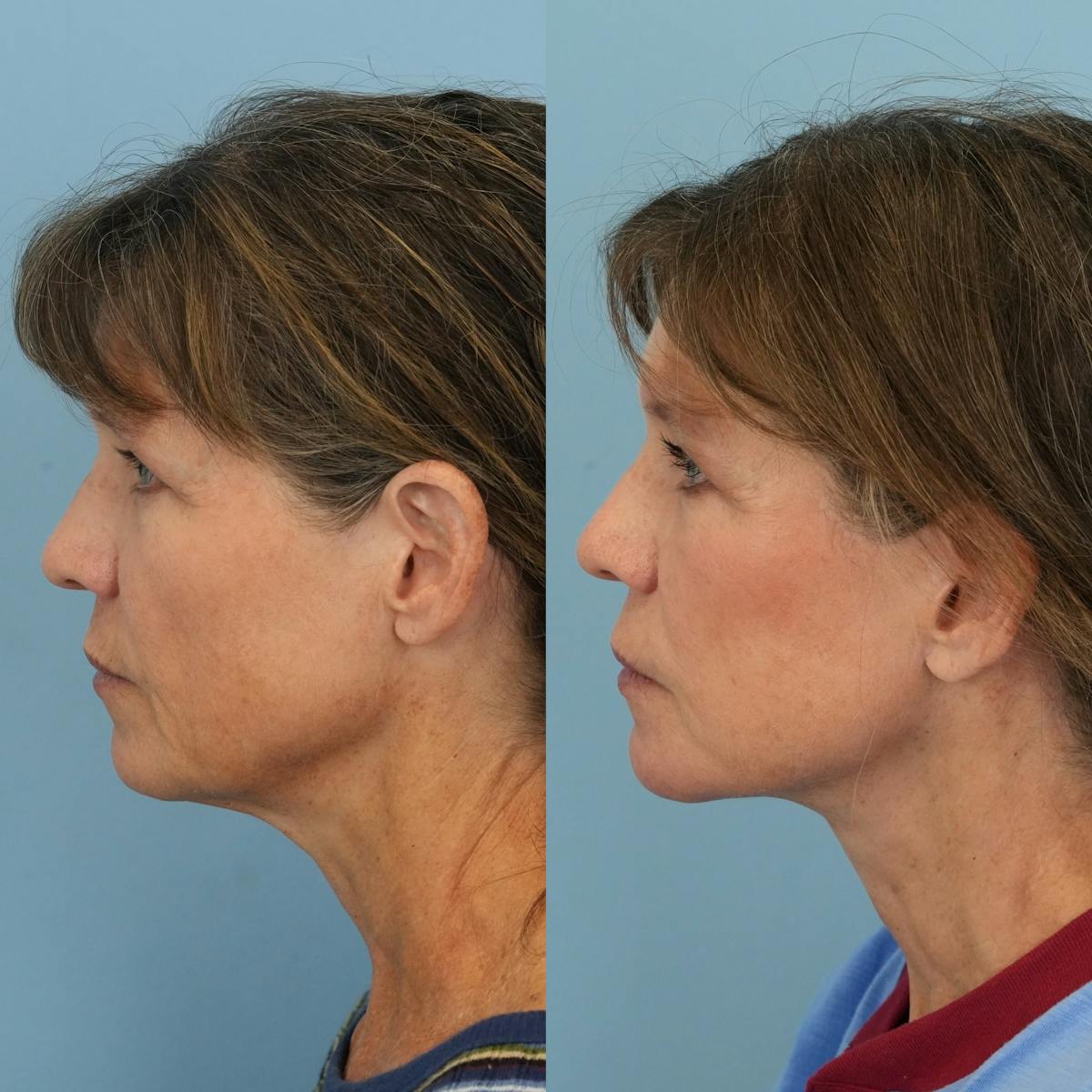 Facelift Before & After Gallery - Patient 222593 - Image 5