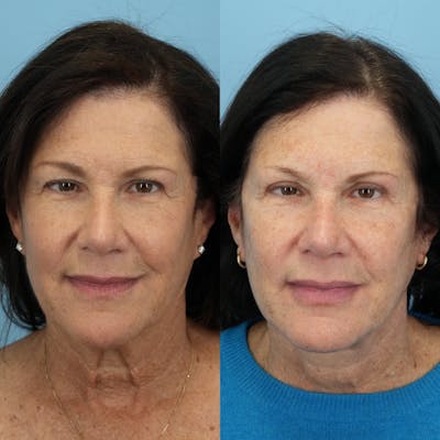 Facelift Before & After Gallery - Patient 103355 - Image 1