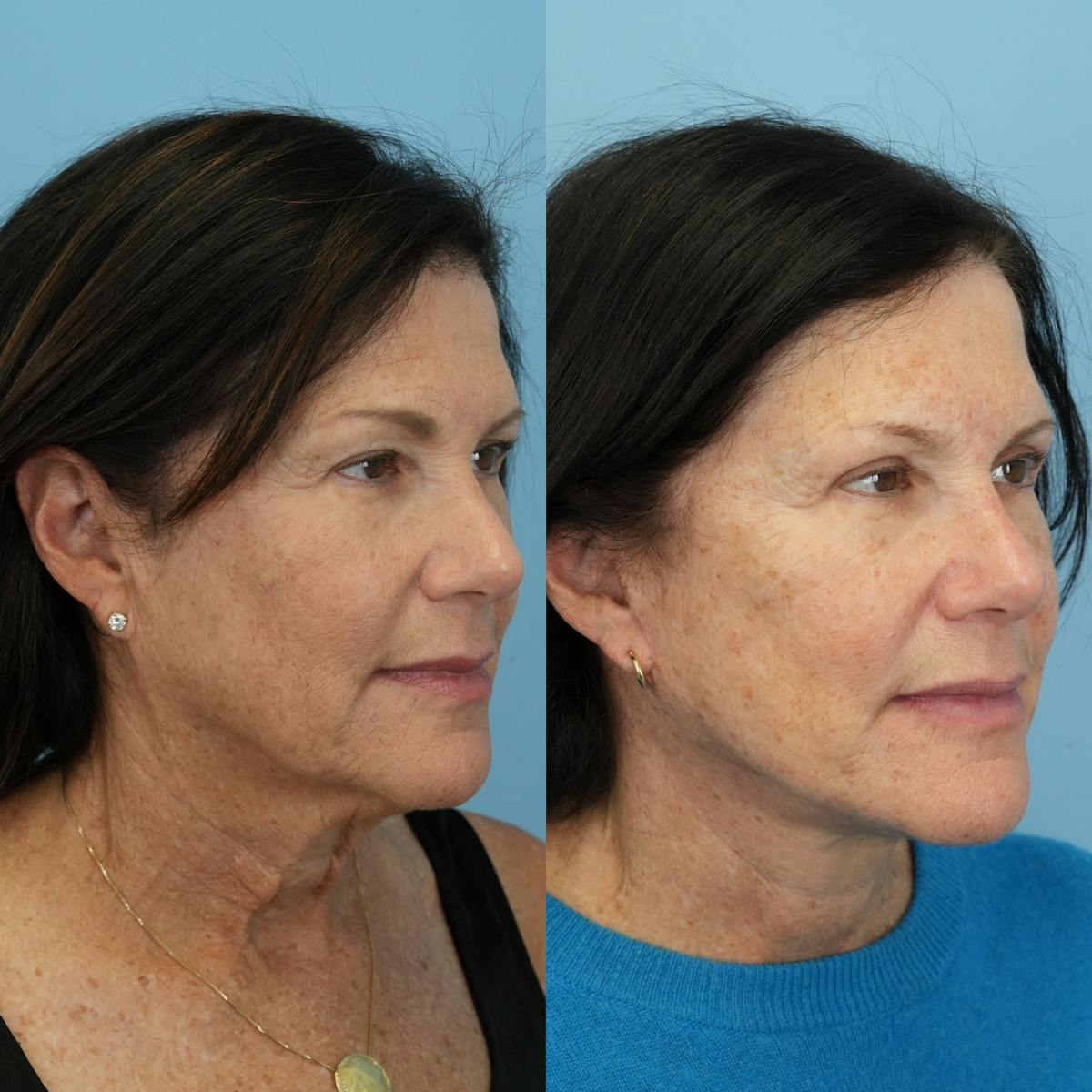 Facelift Before & After Gallery - Patient 103355 - Image 2