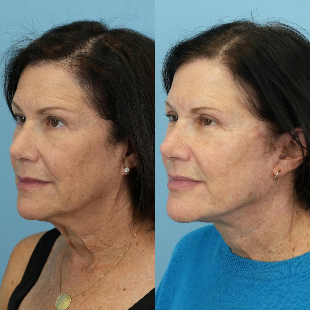 Facelift Before & After Gallery - Patient 103355 - Image 4
