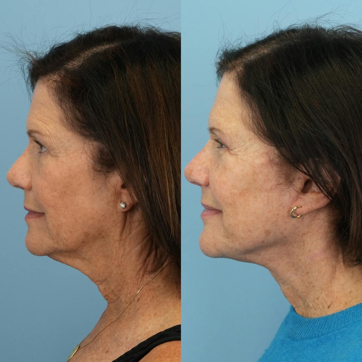 Facelift Before & After Gallery - Patient 103355 - Image 5