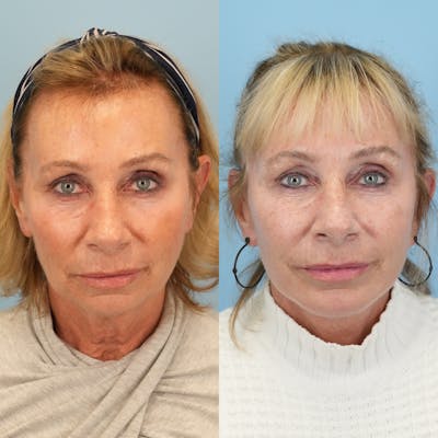 Facelift Before & After Gallery - Patient 163862 - Image 1