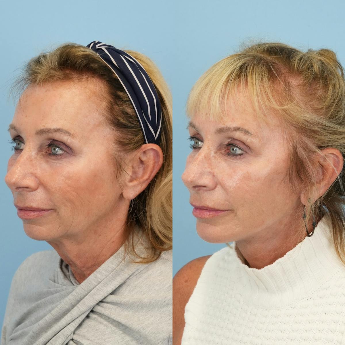 Facelift Before & After Gallery - Patient 163862 - Image 4