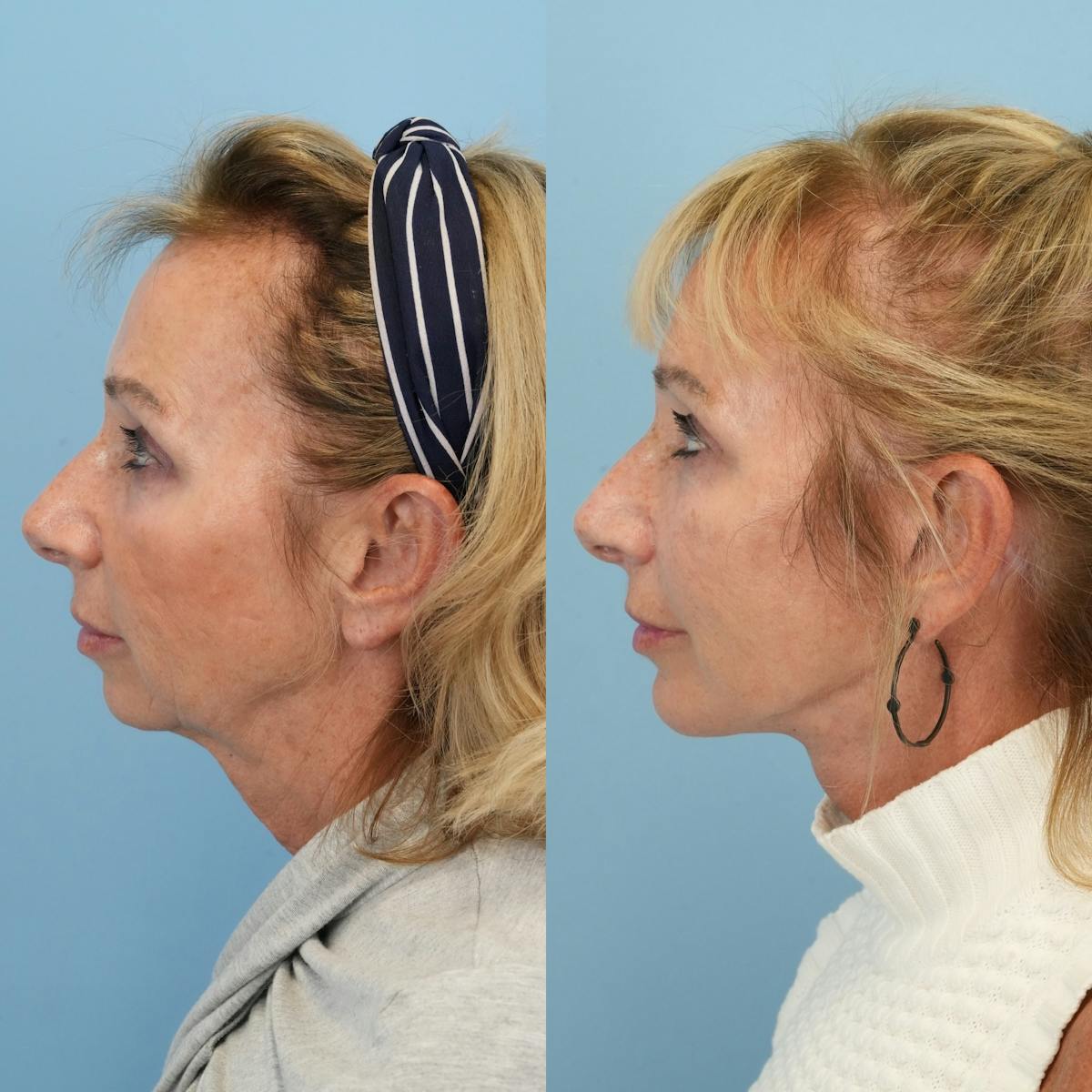 Facelift Before & After Gallery - Patient 163862 - Image 5