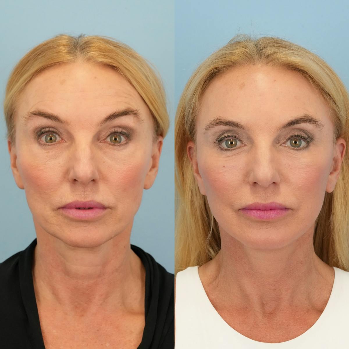 Facelift Before & After Gallery - Patient 136019 - Image 1
