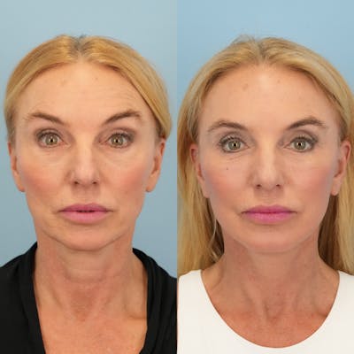 Facelift Before & After Gallery - Patient 136019 - Image 1