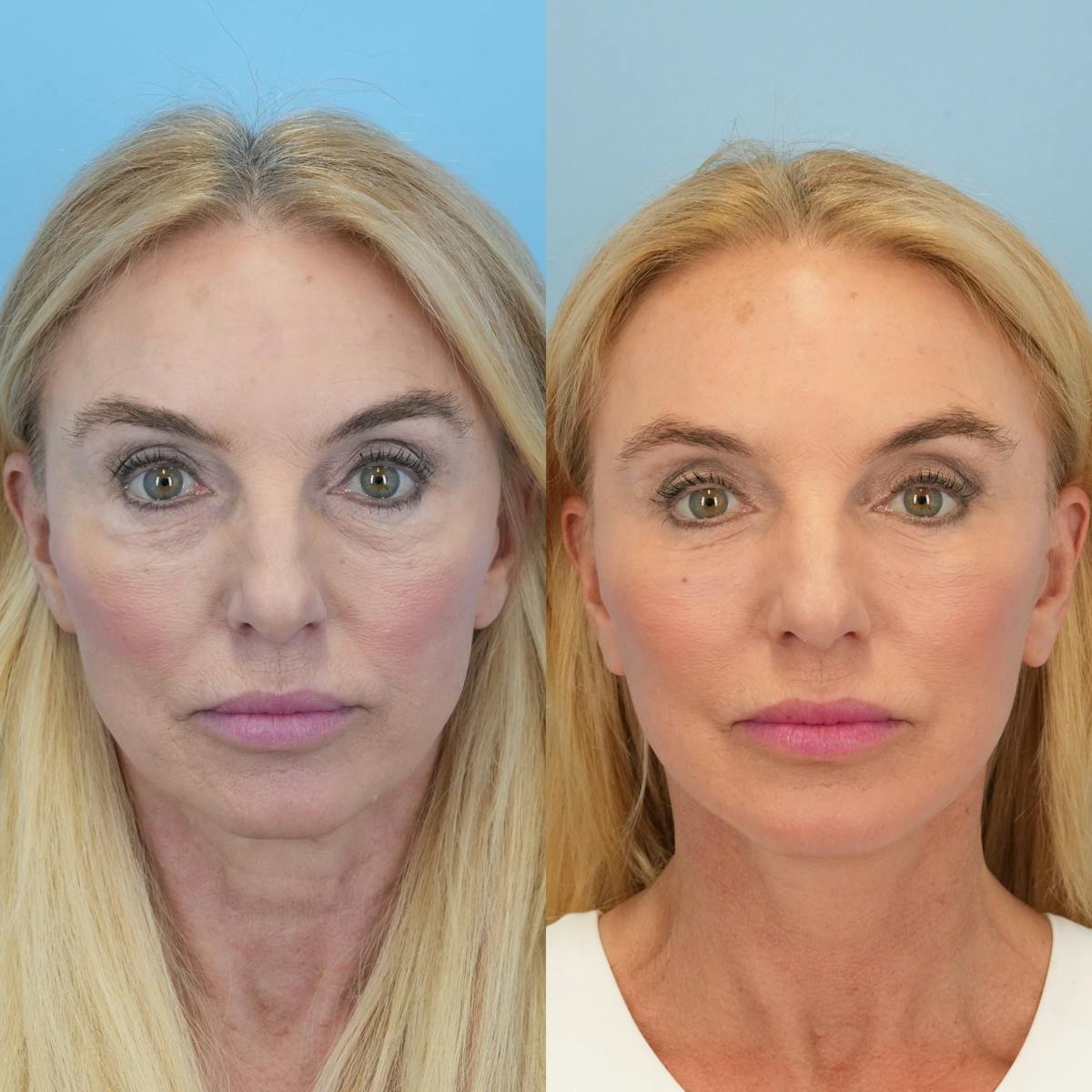 Facelift Before & After Gallery - Patient 136019 - Image 2