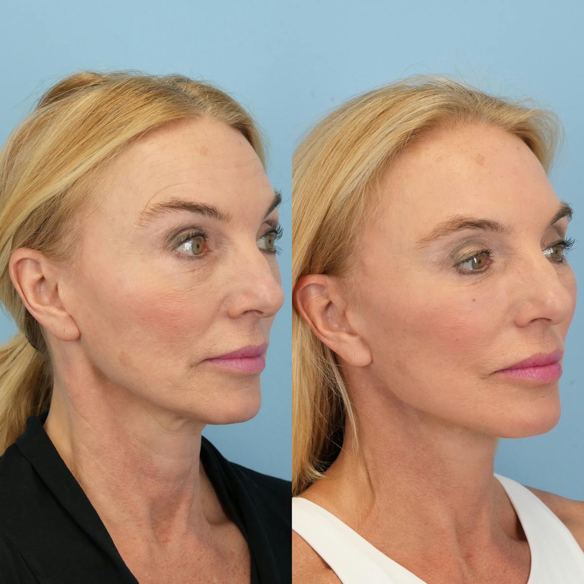 Facelift Before & After Gallery - Patient 136019 - Image 3