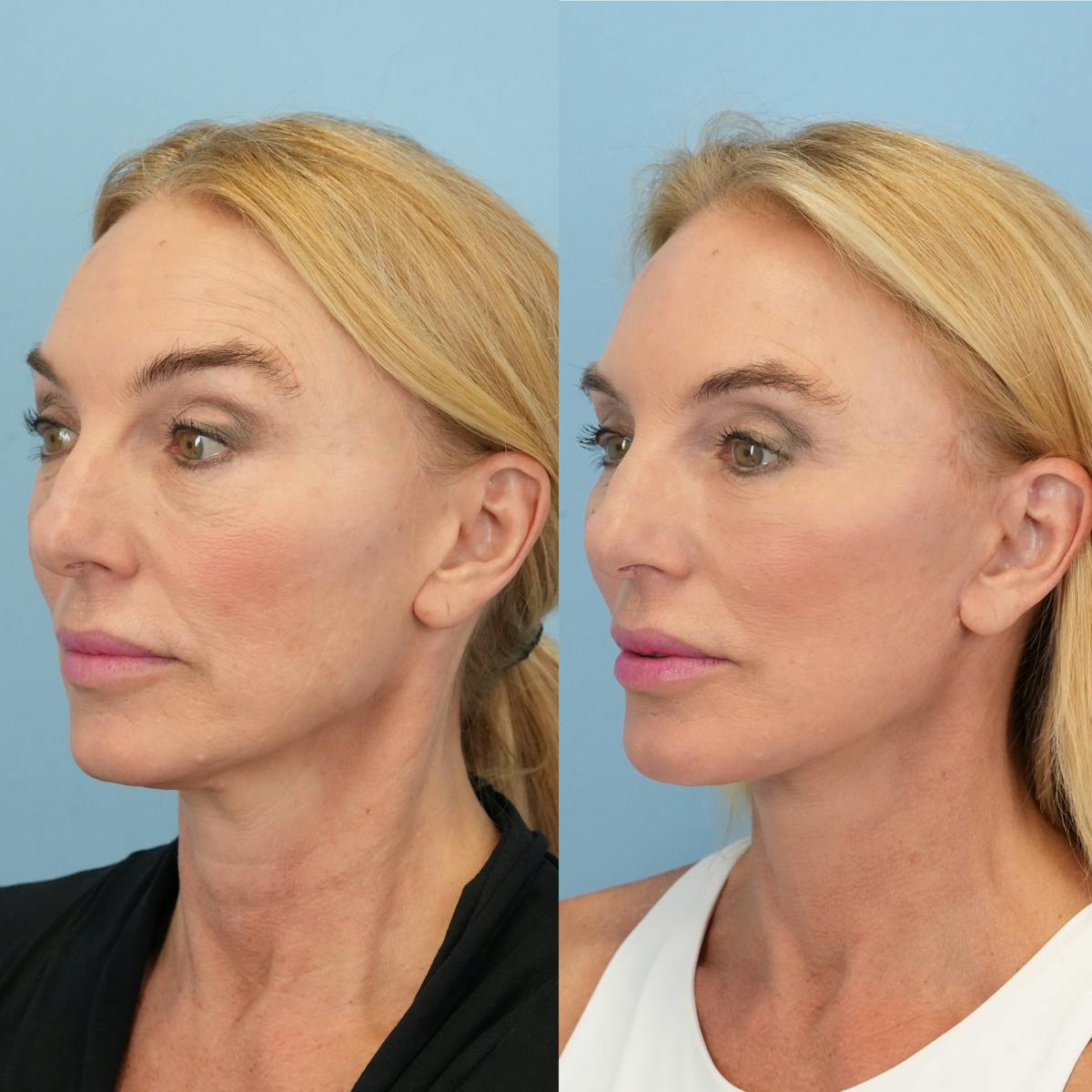 Facelift Before & After Gallery - Patient 136019 - Image 5
