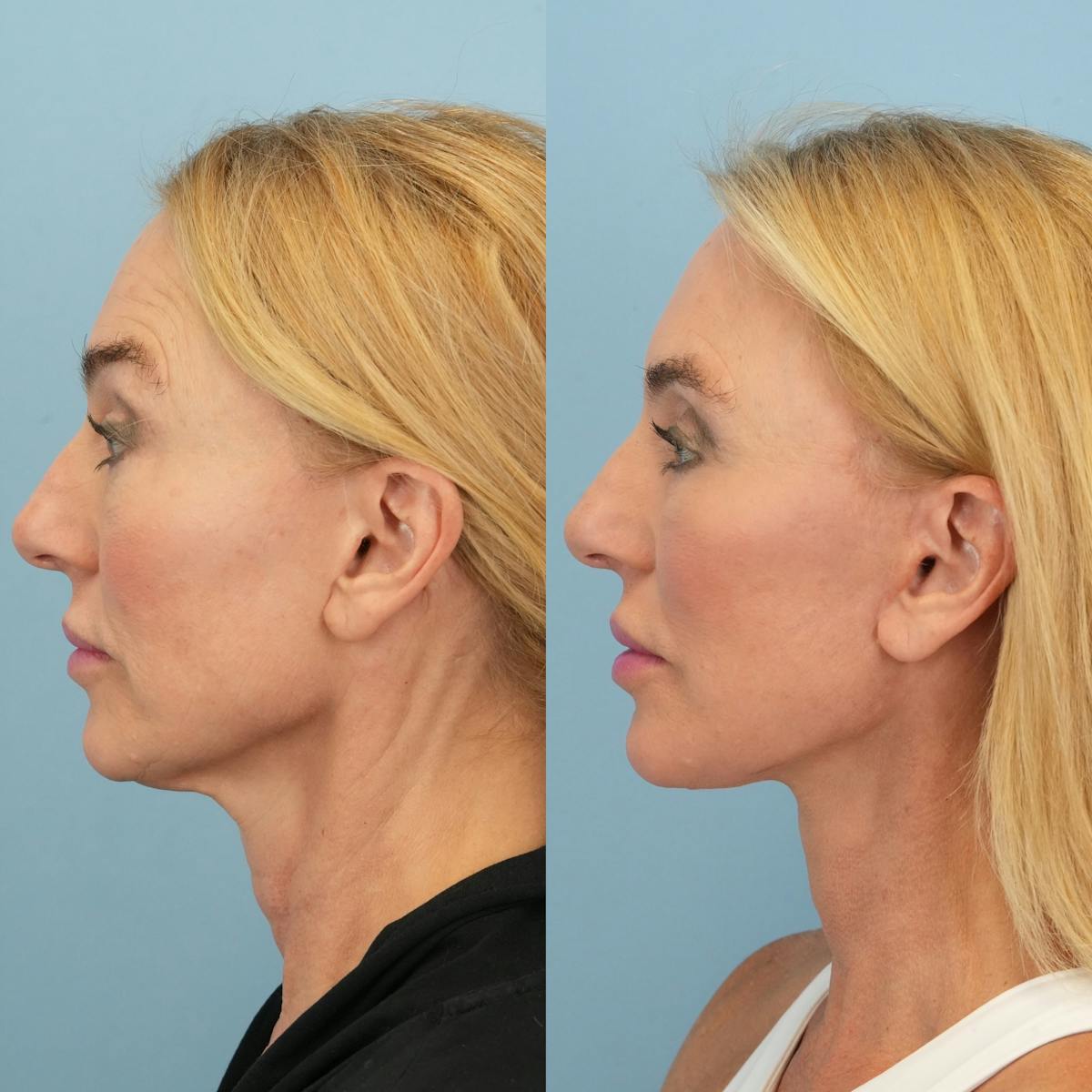Facelift Before & After Gallery - Patient 136019 - Image 6