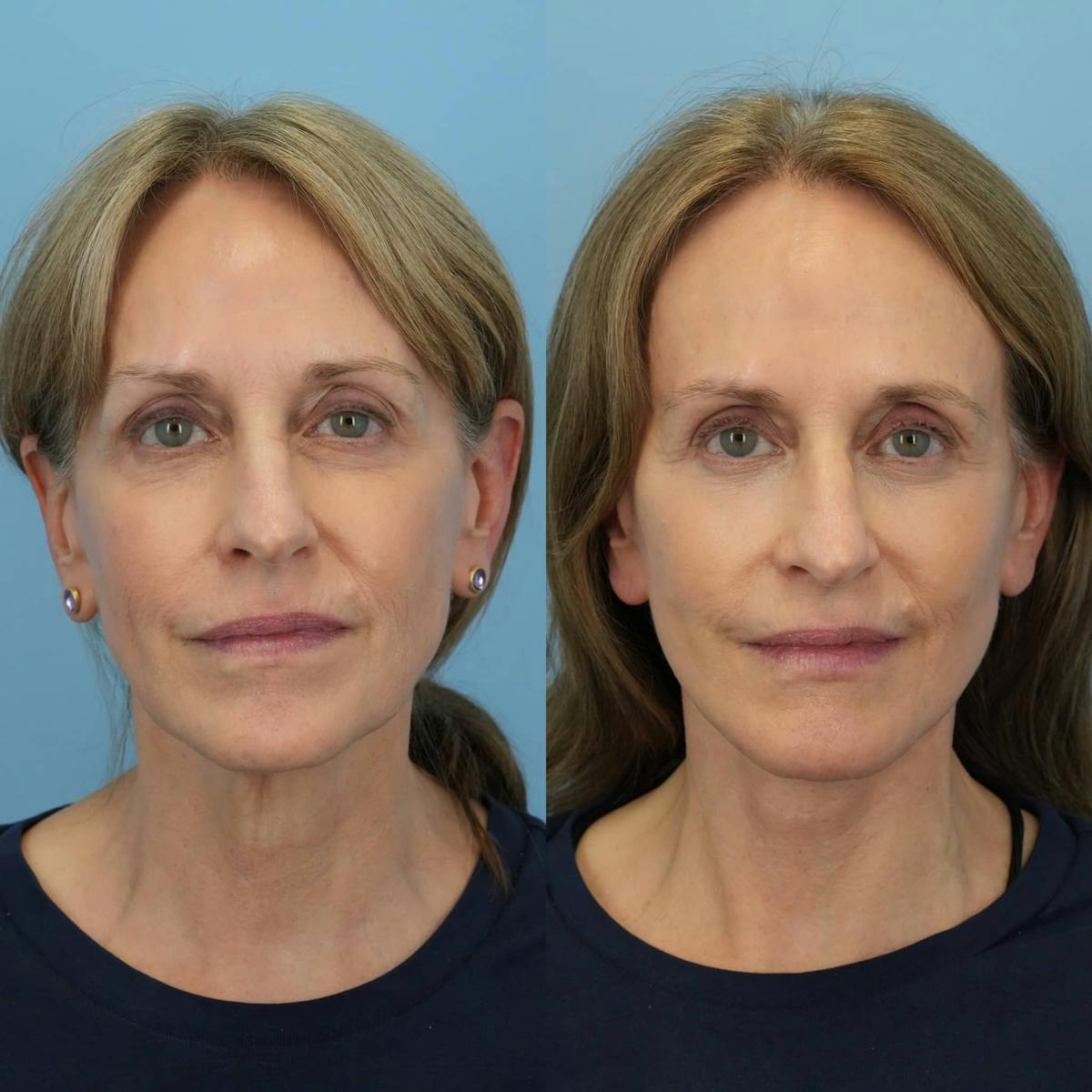 Facelift Before & After Gallery - Patient 252181 - Image 1