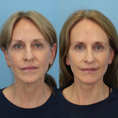 Facelift Before & After Gallery - Patient 252181 - Image 1