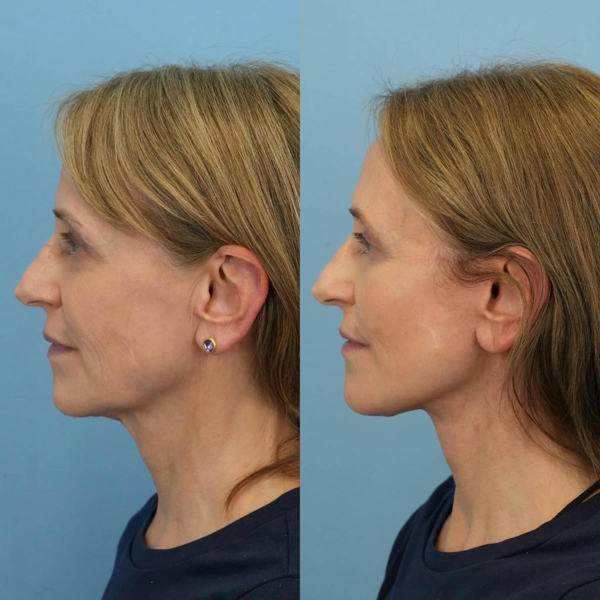 Facelift Before & After Gallery - Patient 252181 - Image 4