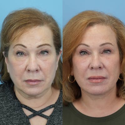 Facelift Before & After Gallery - Patient 860933 - Image 1