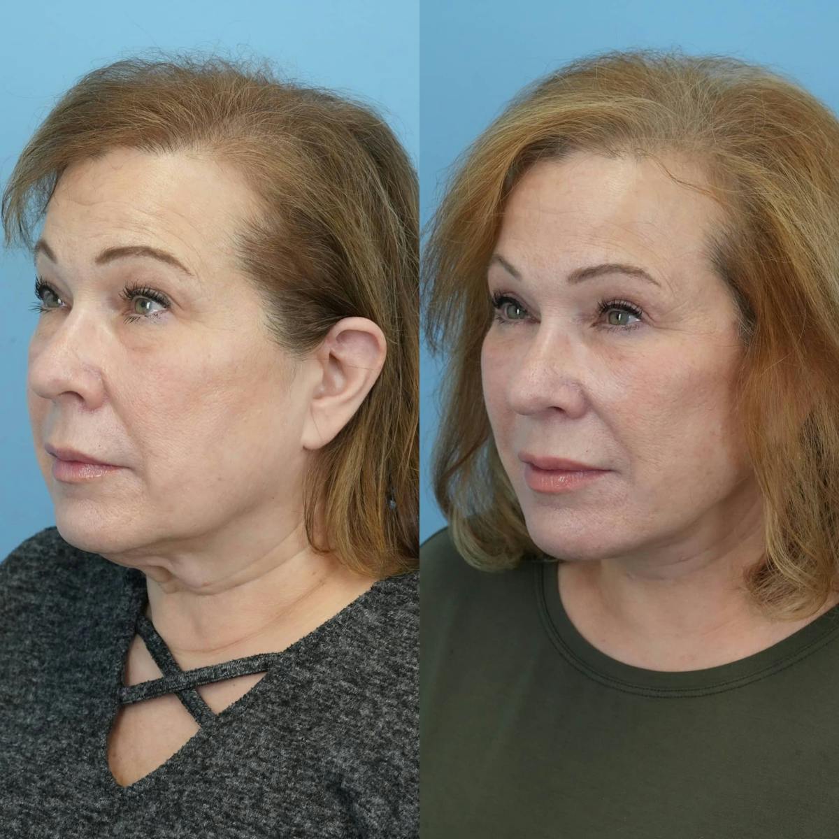 Facelift Before & After Gallery - Patient 860933 - Image 2