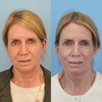Facelift Before & After Gallery - Patient 318543 - Image 1