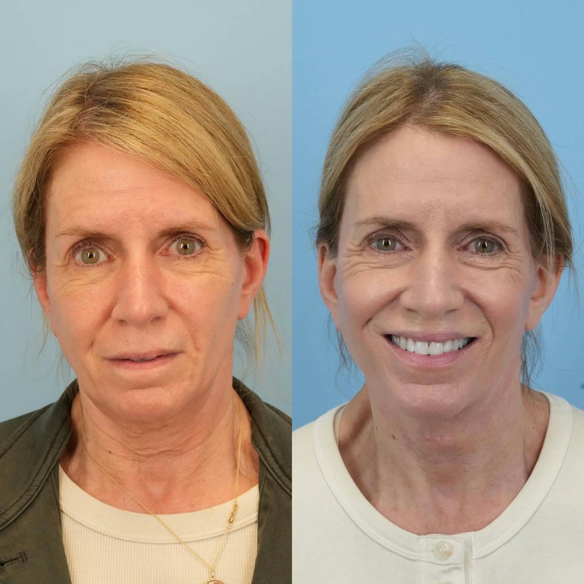 Facelift Before & After Gallery - Patient 318543 - Image 2