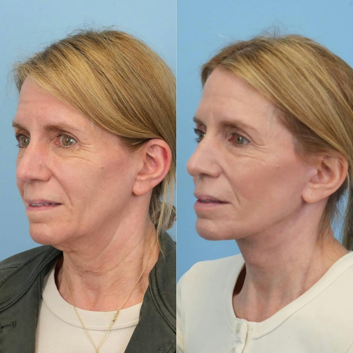 Facelift Before & After Gallery - Patient 318543 - Image 3