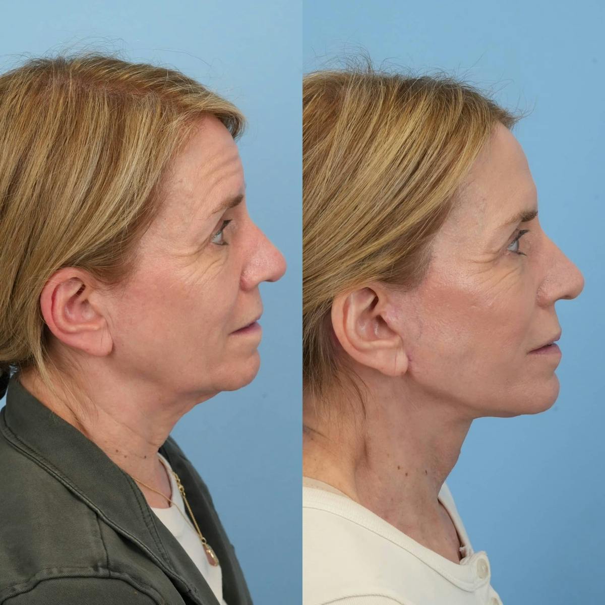 Facelift Before & After Gallery - Patient 318543 - Image 5