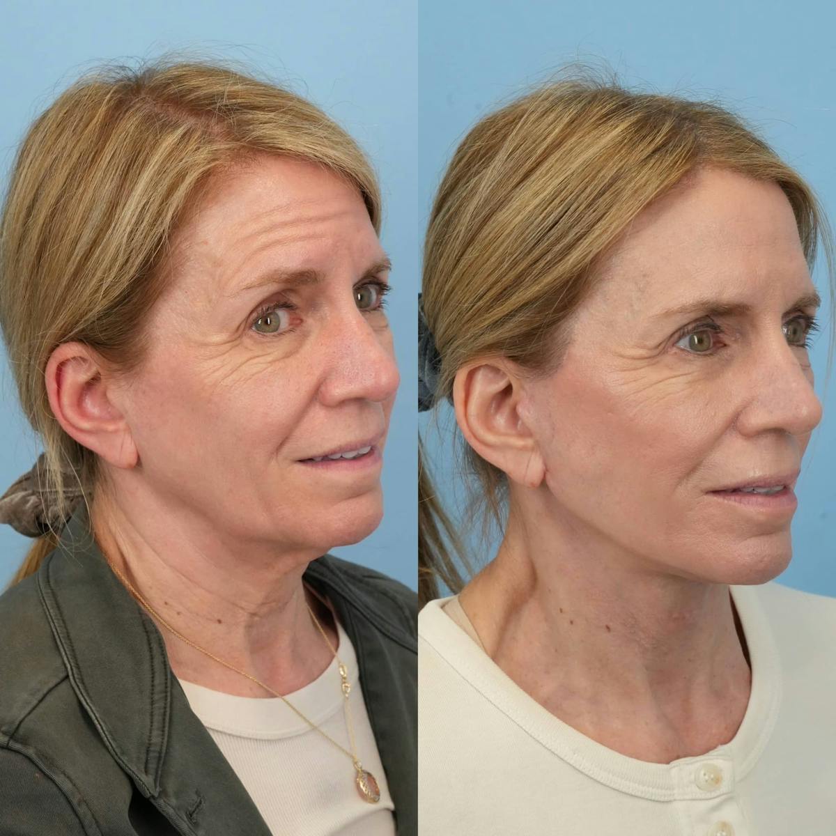 Facelift Before & After Gallery - Patient 318543 - Image 6