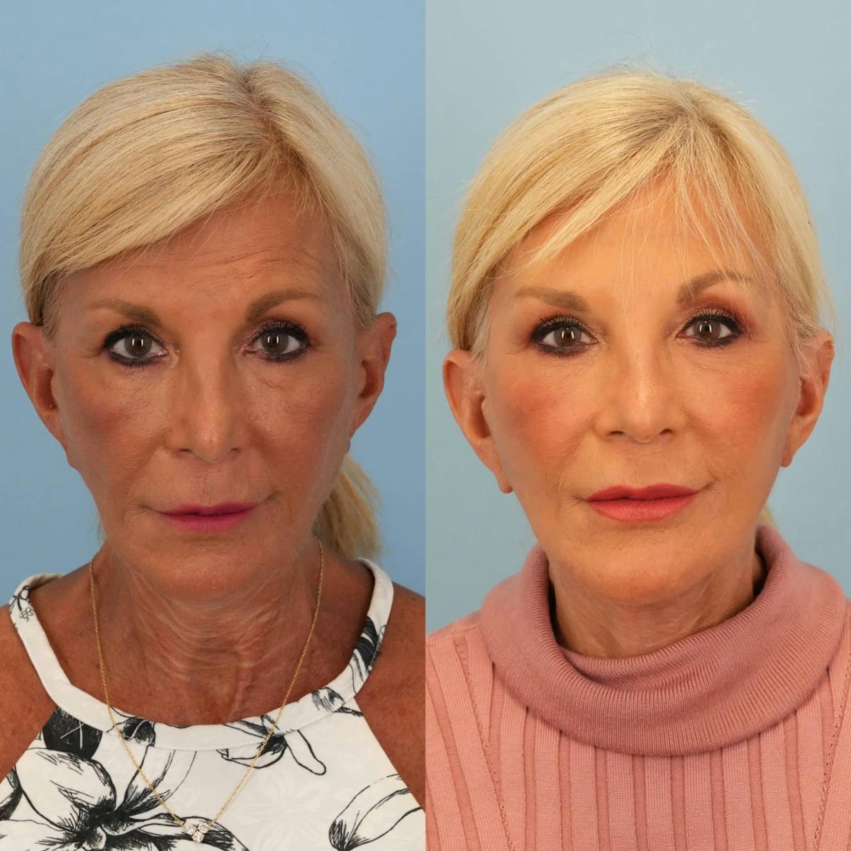Facelift Before & After Gallery - Patient 257851 - Image 1