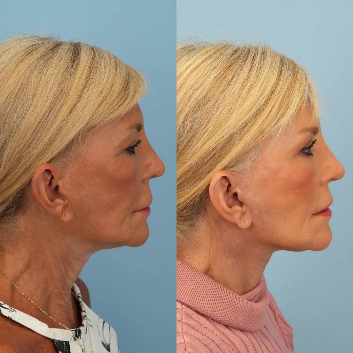 Facelift Before & After Gallery - Patient 257851 - Image 4