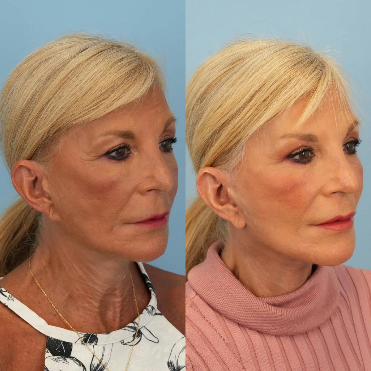 Facelift Before & After Gallery - Patient 257851 - Image 5