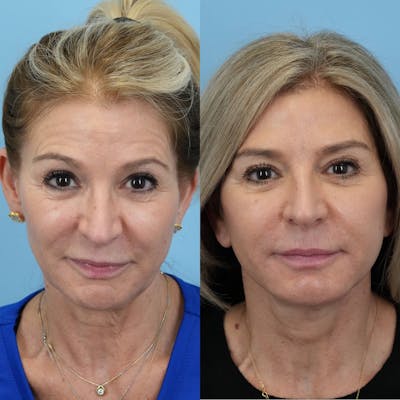 Facelift Before & After Gallery - Patient 940323 - Image 1