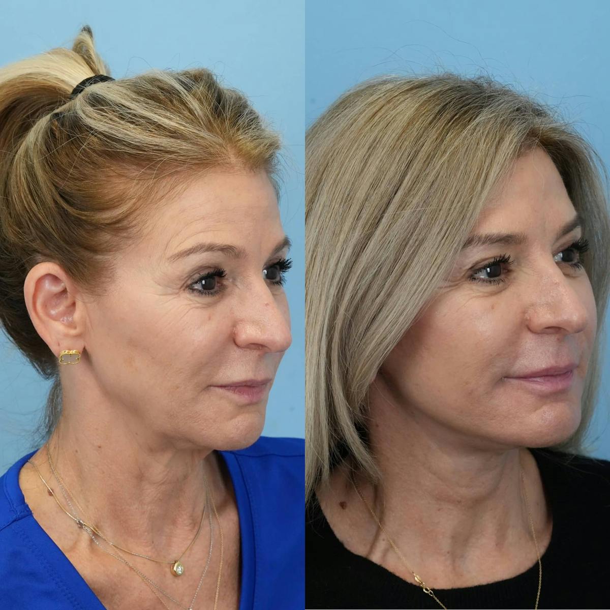 Facelift Before & After Gallery - Patient 940323 - Image 2