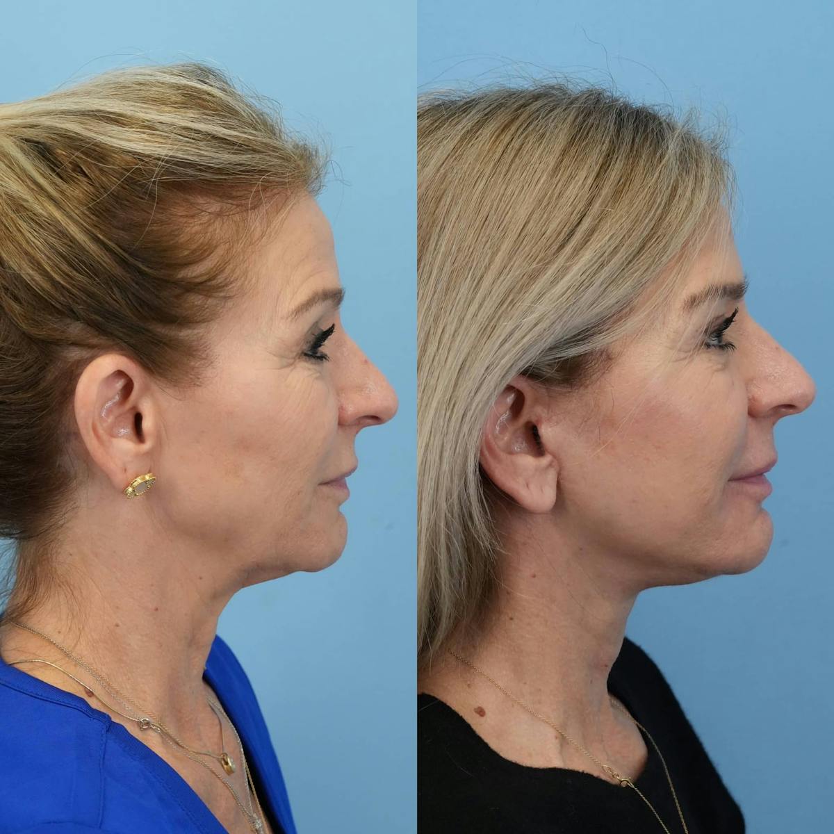 Facelift Before & After Gallery - Patient 940323 - Image 3