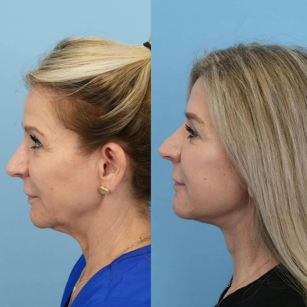 Facelift Before & After Gallery - Patient 940323 - Image 4