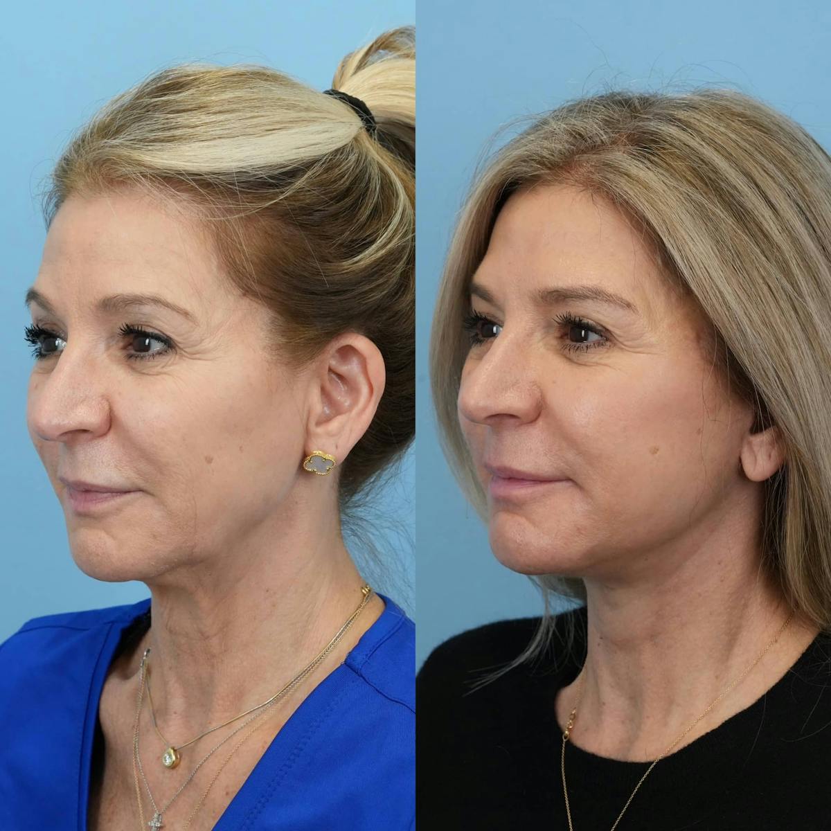 Facelift Before & After Gallery - Patient 940323 - Image 5