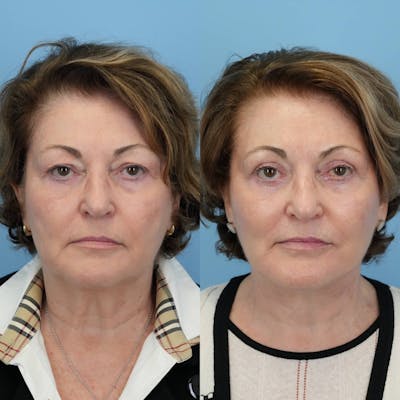 Facelift Before & After Gallery - Patient 353167 - Image 1