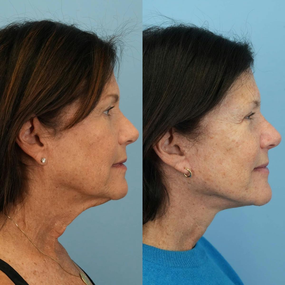 Facelift Before & After Gallery - Patient 129055 - Image 3