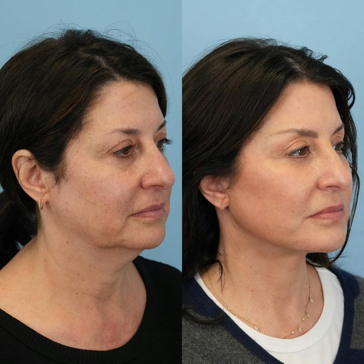 Facelift Before & After Gallery - Patient 264984 - Image 2