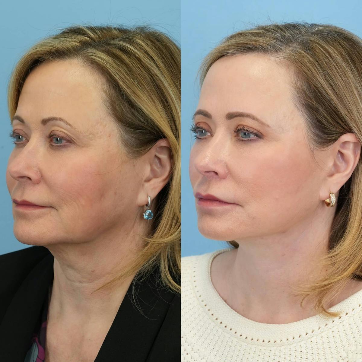 Facelift Before & After Gallery - Patient 130567 - Image 2