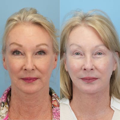 Facelift Before & After Gallery - Patient 278547 - Image 1