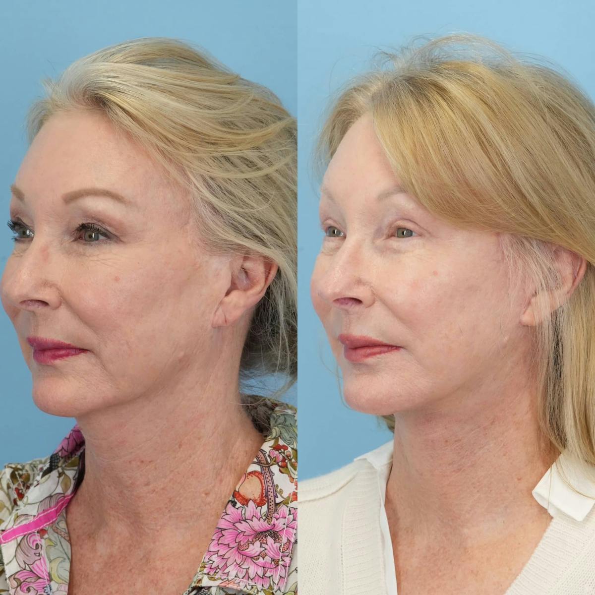 Facelift Before & After Gallery - Patient 278547 - Image 2