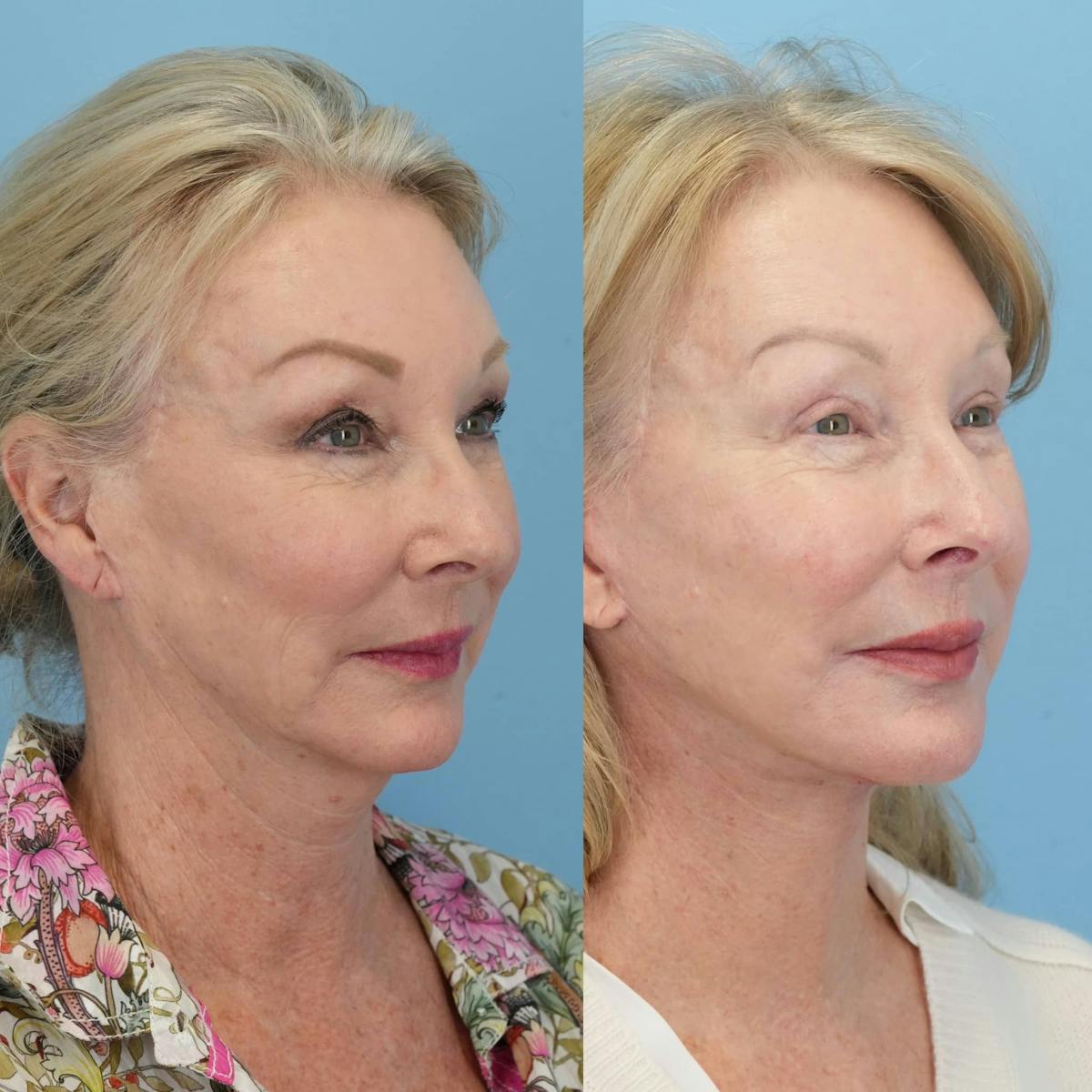 Facelift Before & After Gallery - Patient 278547 - Image 5