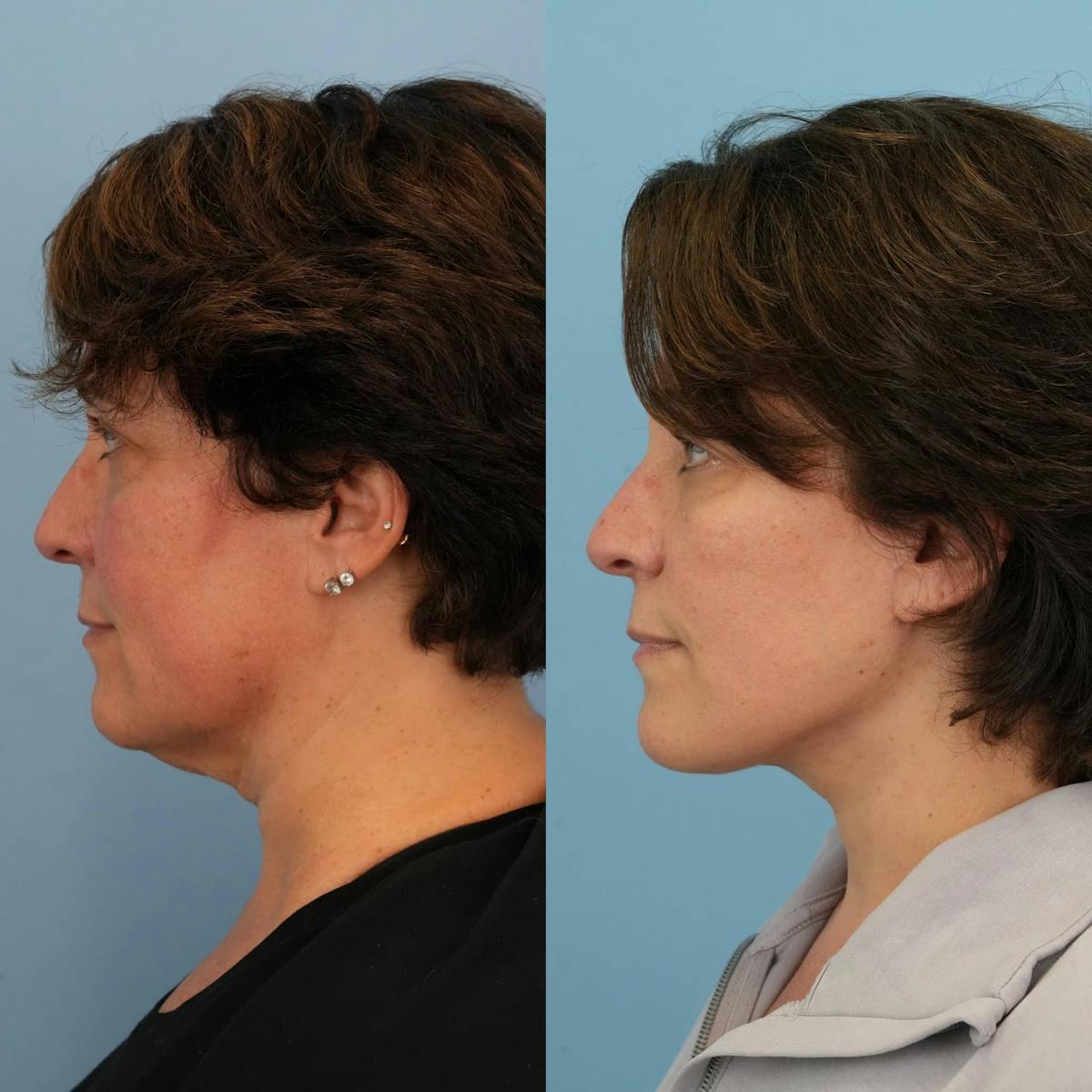 Facelift Before & After Gallery - Patient 308951 - Image 4