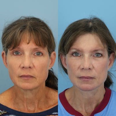 Facelift Before & After Gallery - Patient 308417 - Image 1
