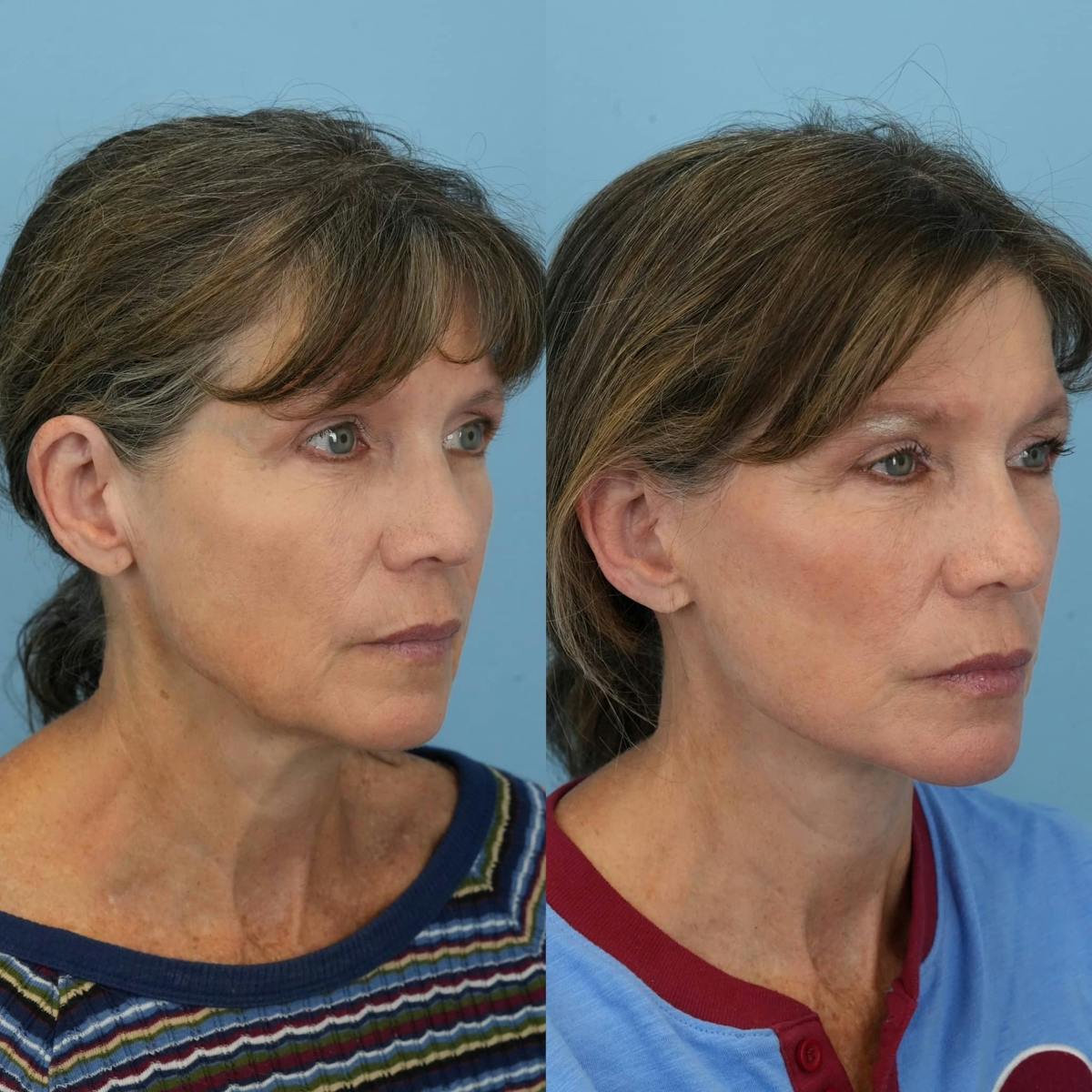 Facelift Before & After Gallery - Patient 308417 - Image 2