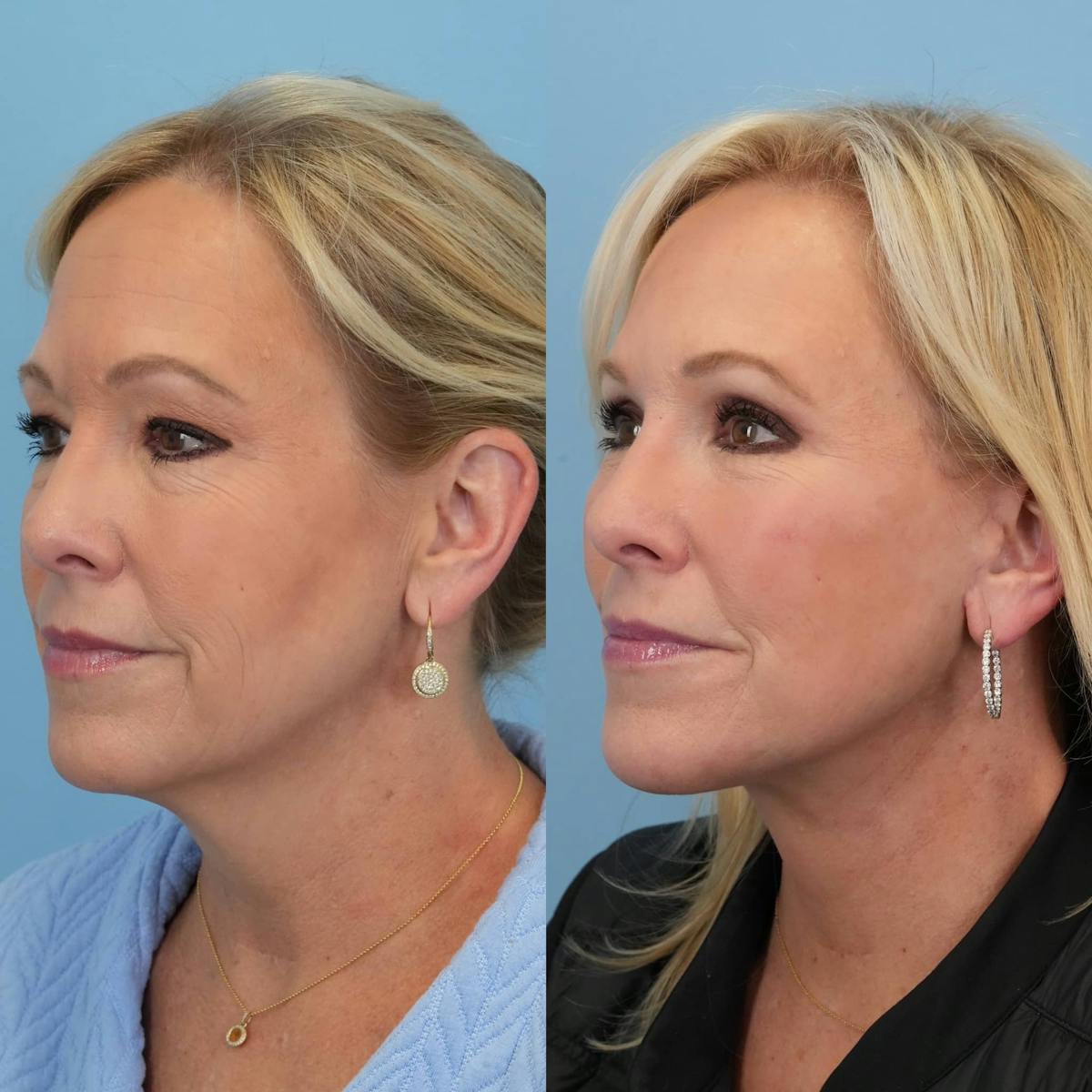 Facelift Before & After Gallery - Patient 240757 - Image 3