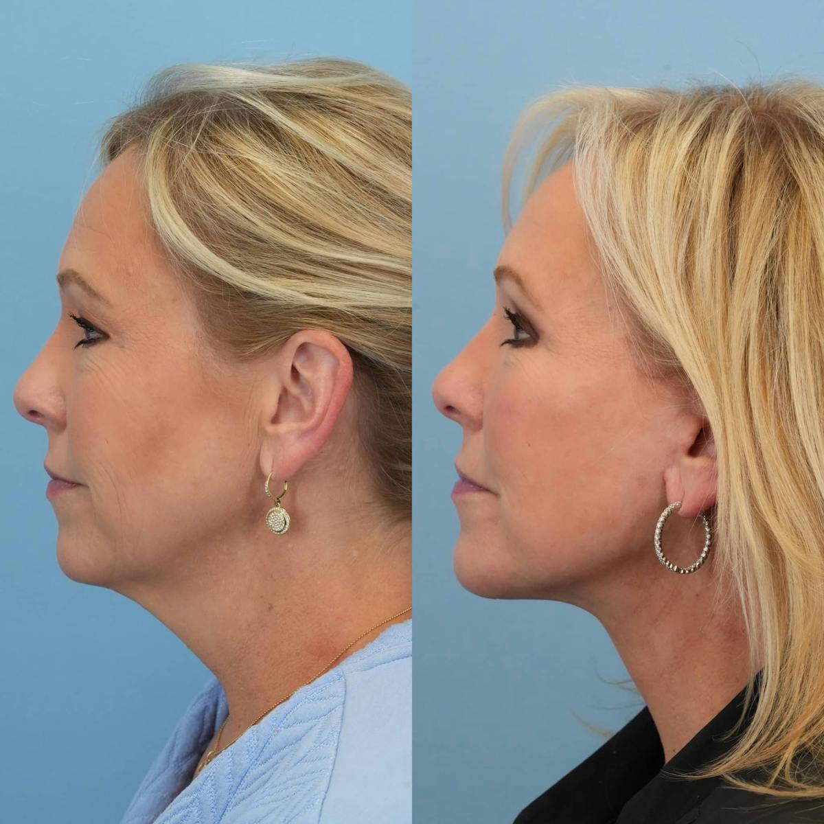 Facelift Before & After Gallery - Patient 240757 - Image 4