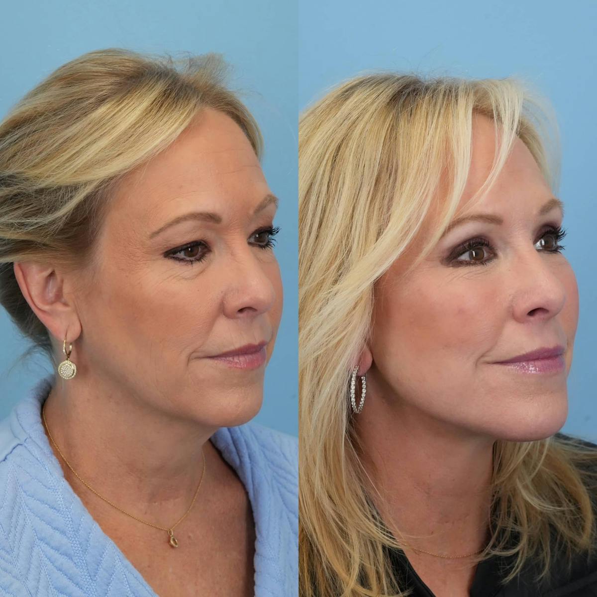 Facelift Before & After Gallery - Patient 240757 - Image 6
