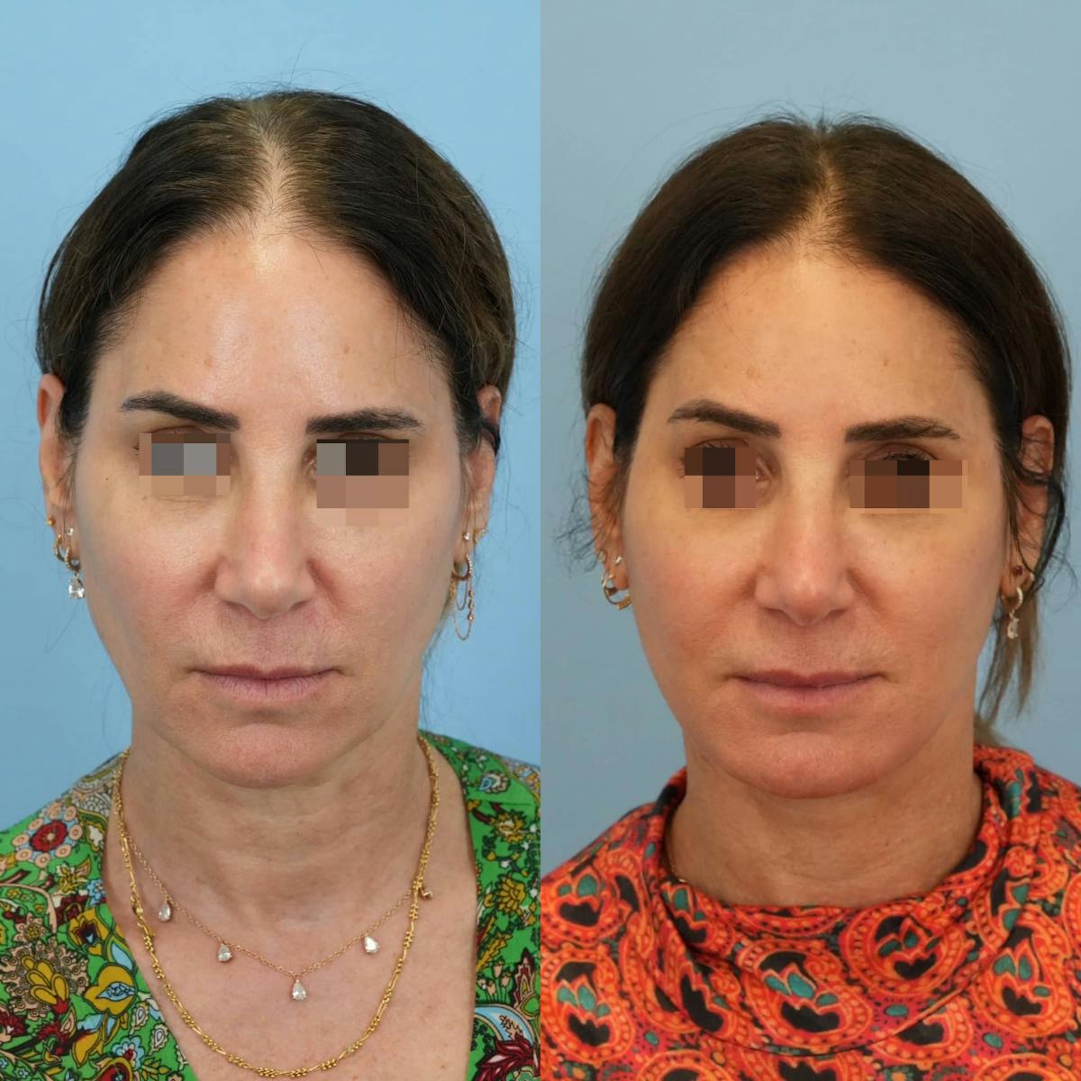 Facelift Before & After Gallery - Patient 244177 - Image 1
