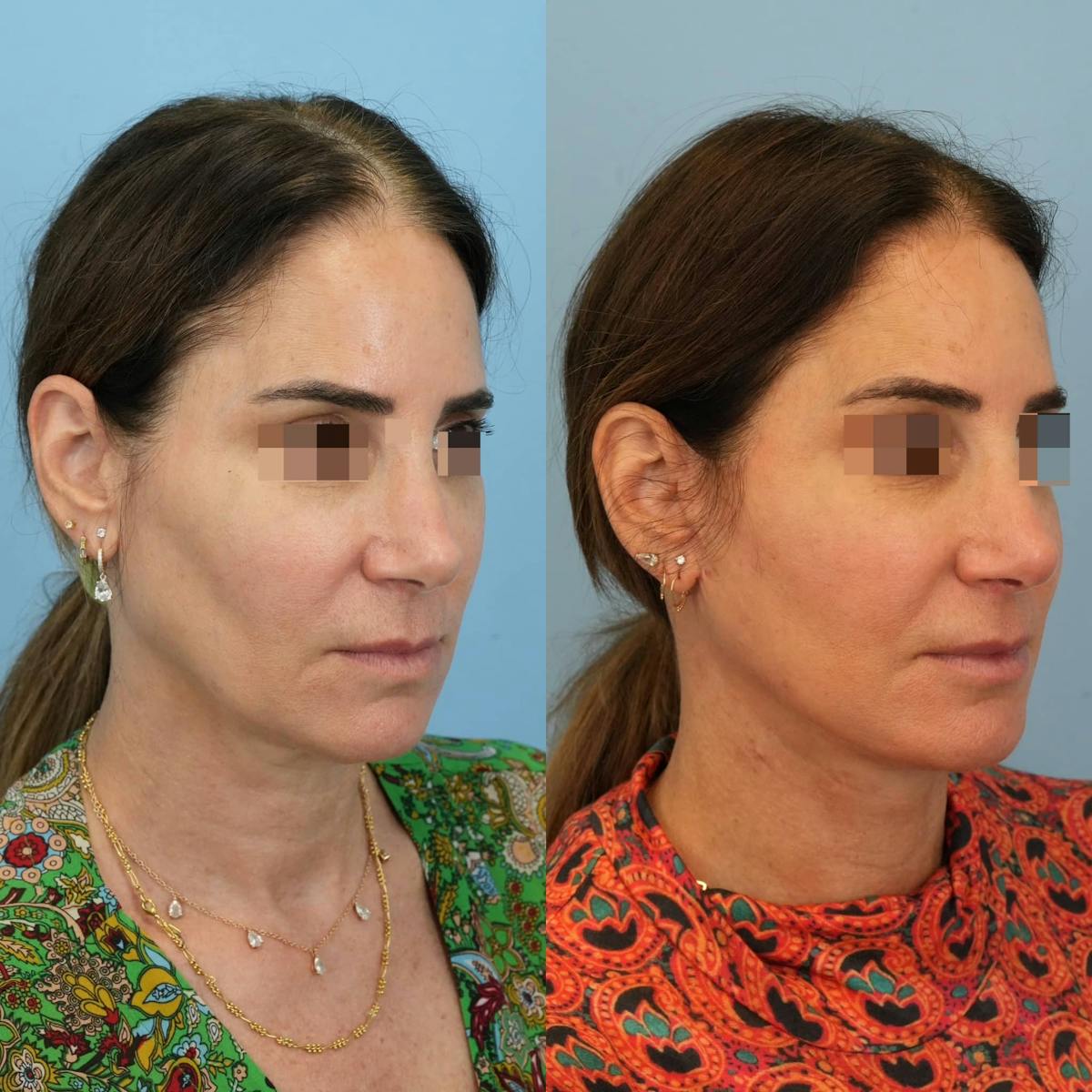 Facelift Before & After Gallery - Patient 244177 - Image 2