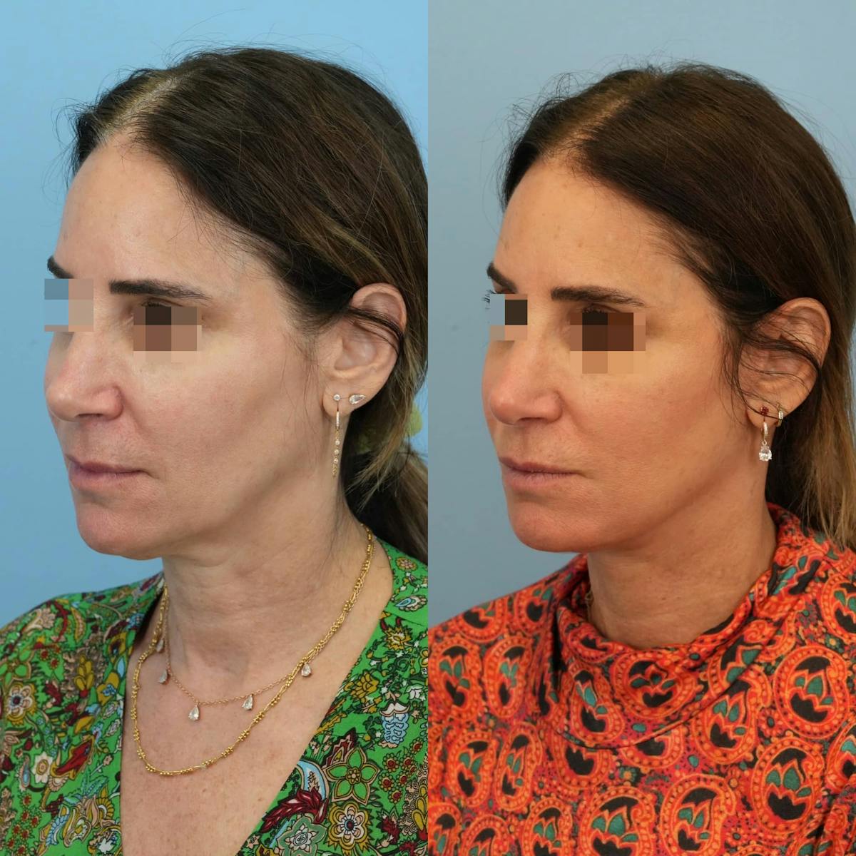 Facelift Before & After Gallery - Patient 244177 - Image 5